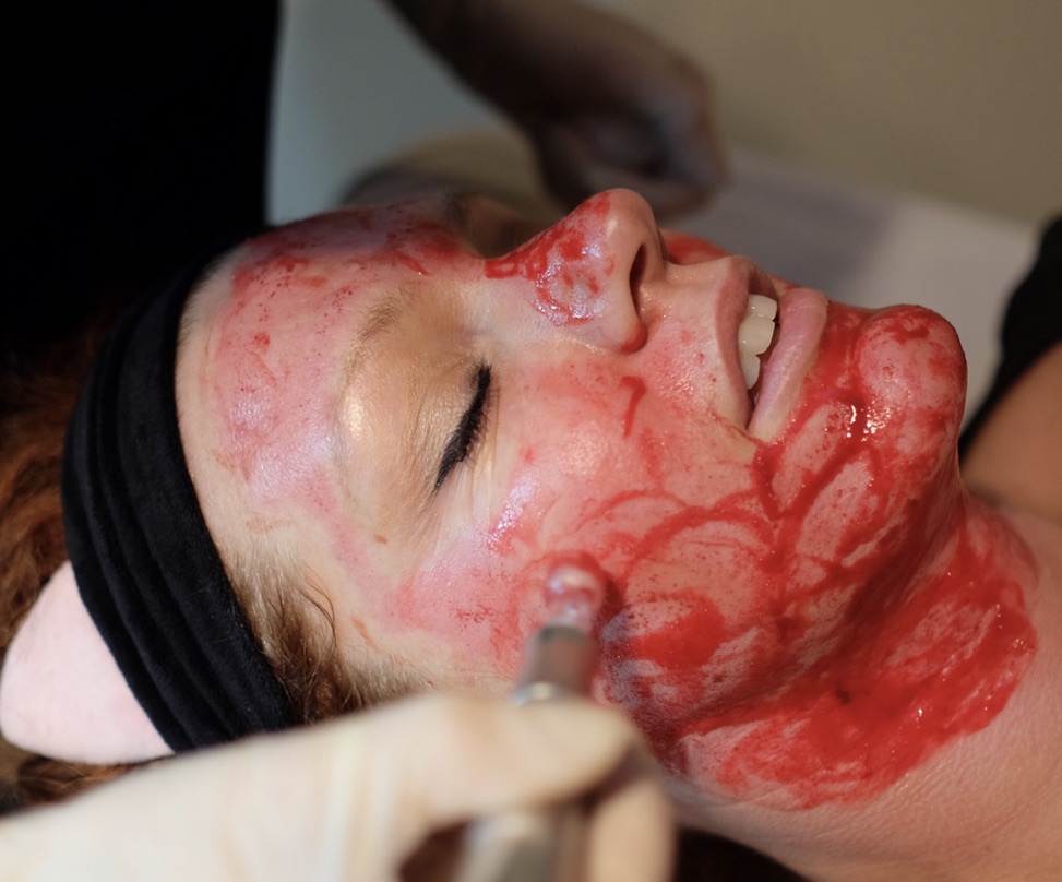 Professional microneedling treatment showing proper technique and application with enhanced serum absorption for collagen induction therapy