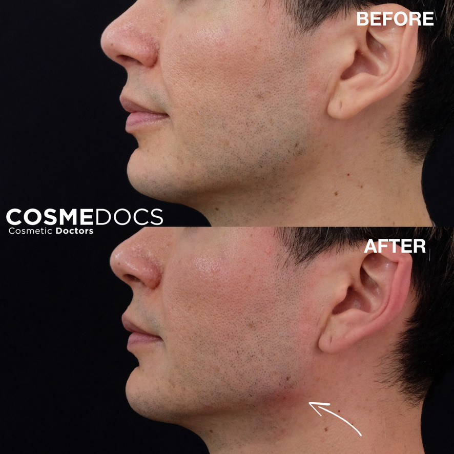 Advanced jawline sculpting and lower face enhancement before and after results