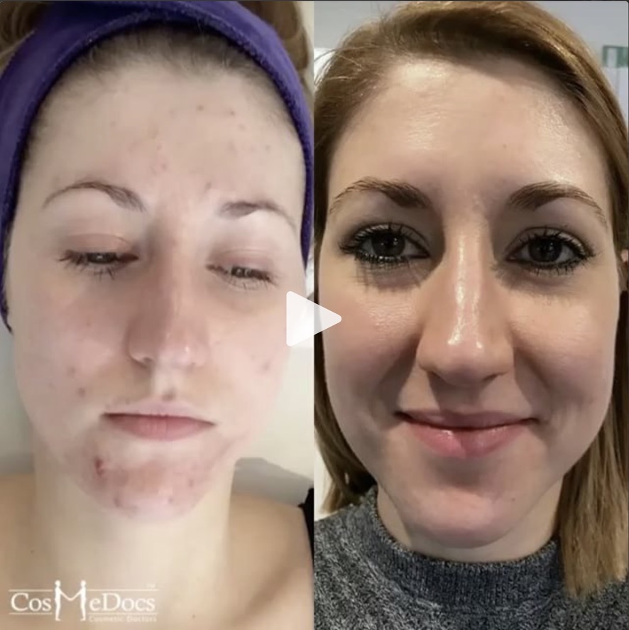 Before treatment for Acne Scarring & Skin Texture