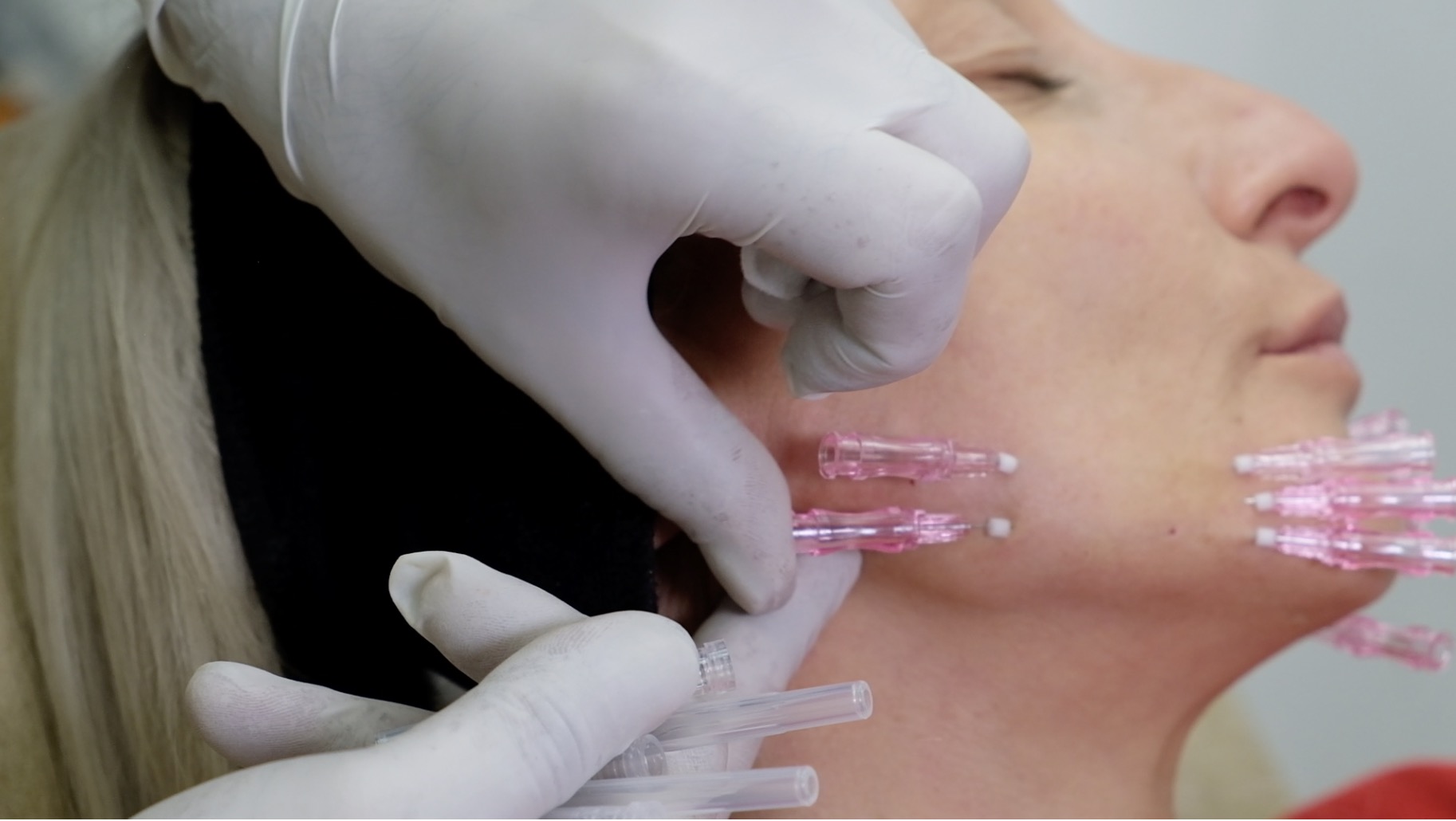 PDO thread insertion technique