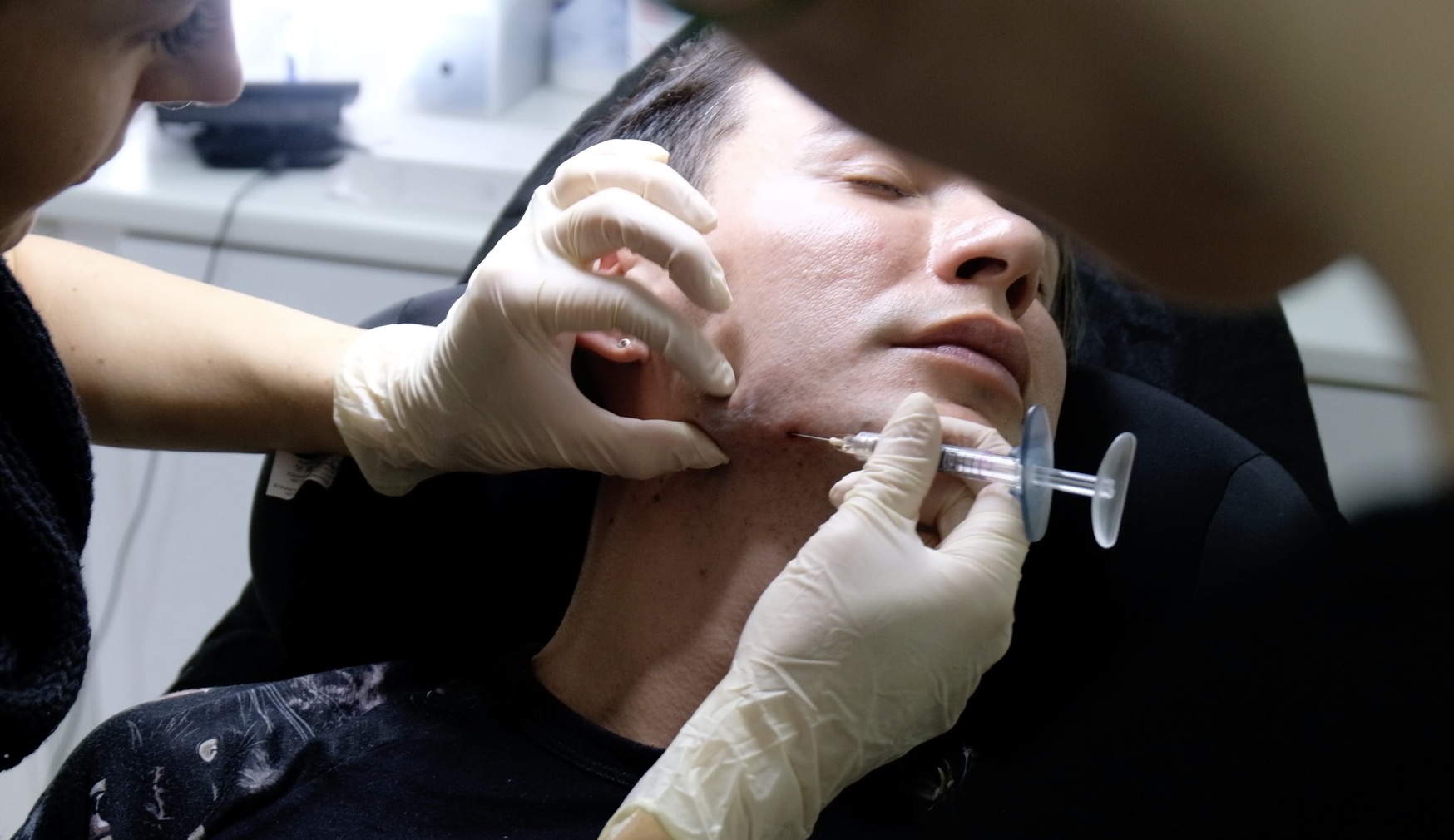 Advanced jawline contouring procedure using multi-layered rejuvenation techniques