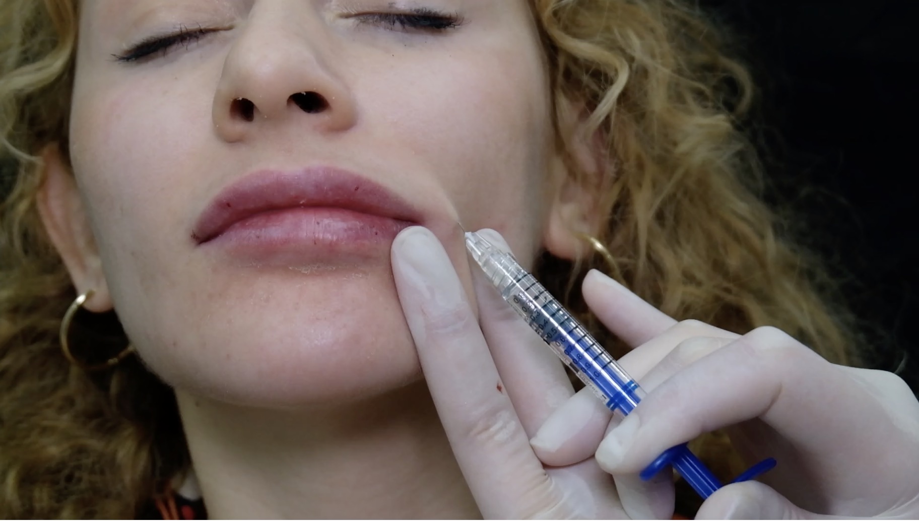 Healthcare professional performing advanced facial aesthetic treatment with multi-layering technique