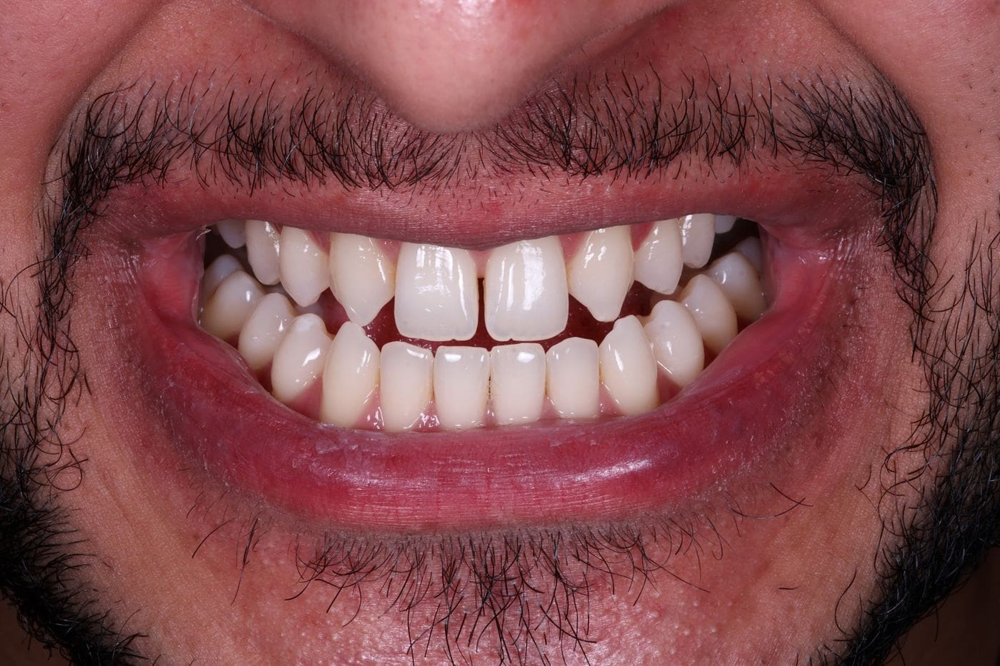 Ceramic veneer restorations on anterior teeth